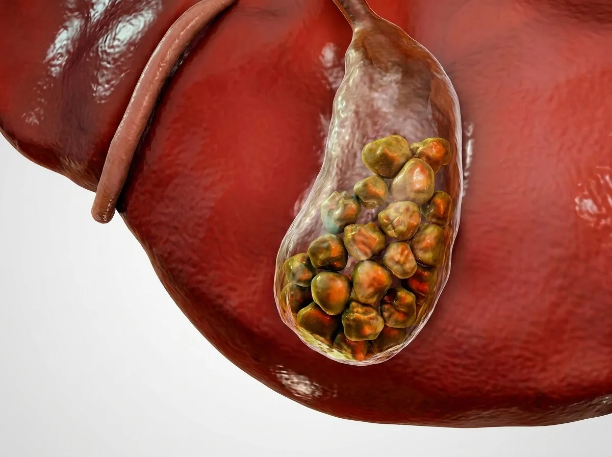 Gallstones